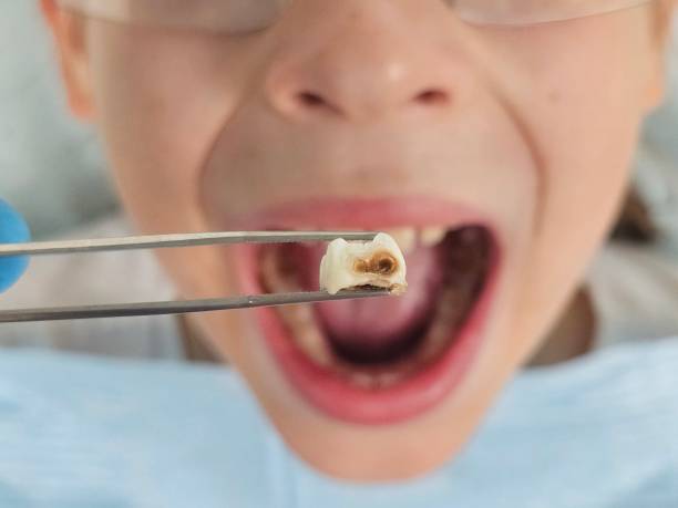 Best Emergency Wisdom Teeth Removal in Bismarck, MO